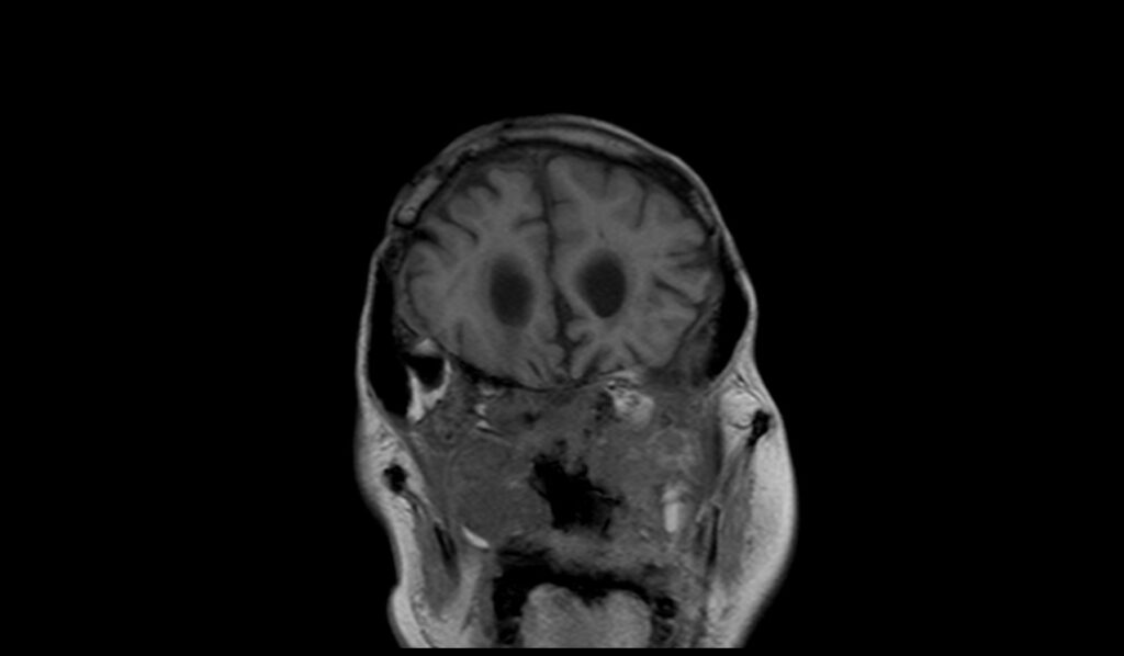 Clival Chordoma MRI | Radiology Article on Clival Chordoma