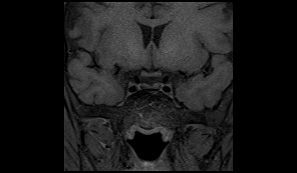 Pituitary Iron Overload (hemochromatosis) Mri 