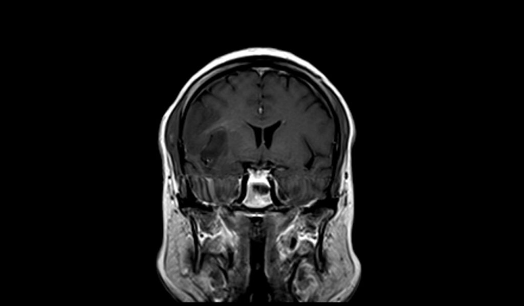 Oligodendroglioma MRI | Radiology Article on Oligodendroglioma