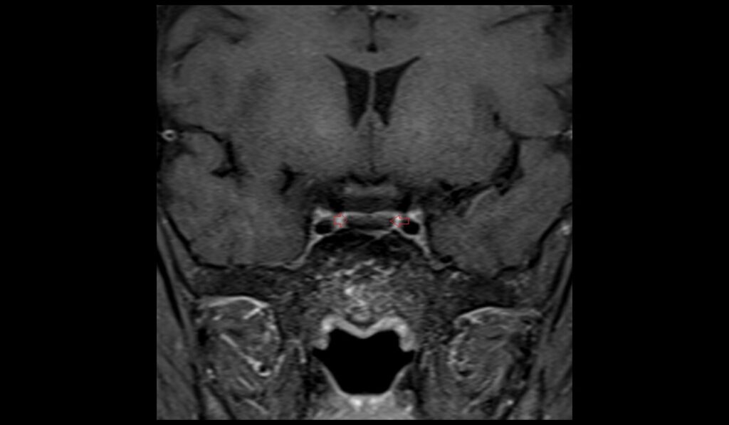 Pituitary Iron Overload (hemochromatosis) MRI | Radiology Article on ...