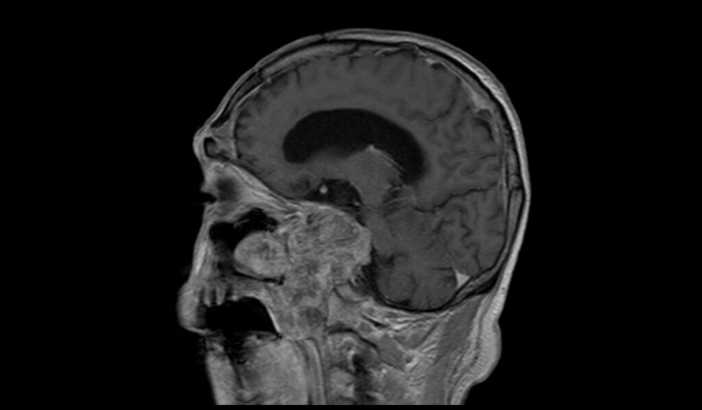 Clival Chordoma MRI | Radiology Article on Clival Chordoma