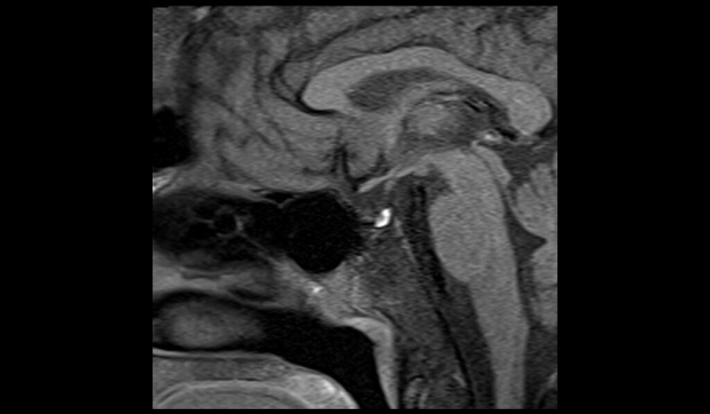 Pituitary Iron Overload (hemochromatosis) Mri 