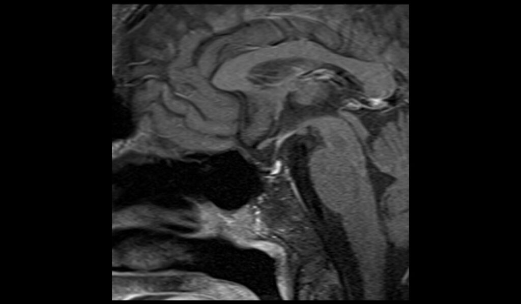 Pituitary Iron Overload (hemochromatosis) MRI | Radiology Article on ...