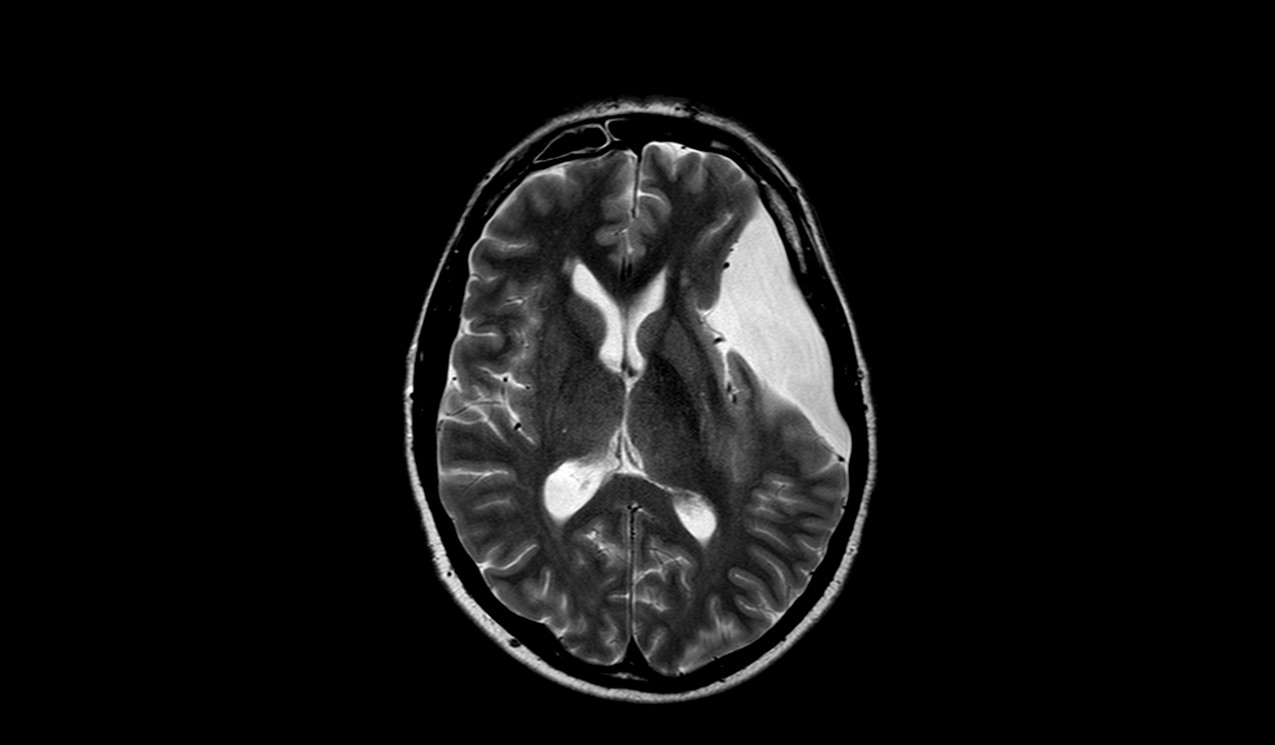 Arachnoid Cyst Mri Radiology Article On Arachnoid Cyst