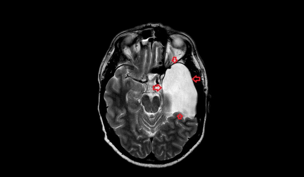 Arachnoid Cyst Mri Radiology Article On Arachnoid Cyst 7325