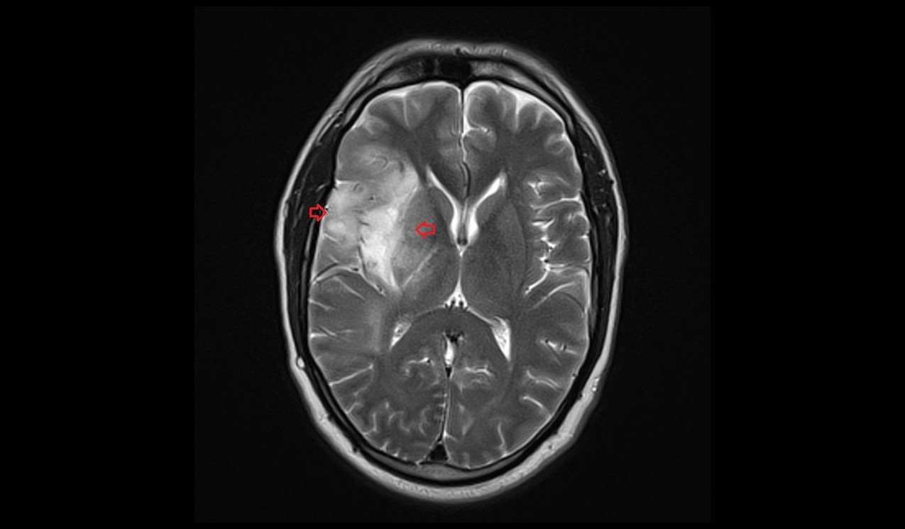 Oligodendroglioma MRI Radiology Article on Oligodendroglioma