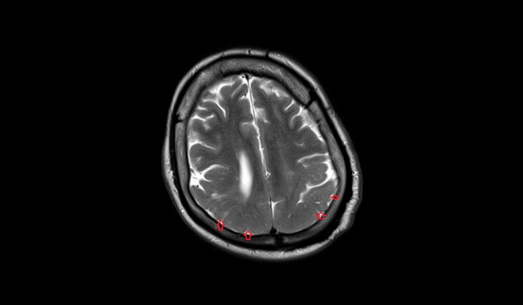 Pachygyria MRI | Radiology Article on Oligodendroglioma