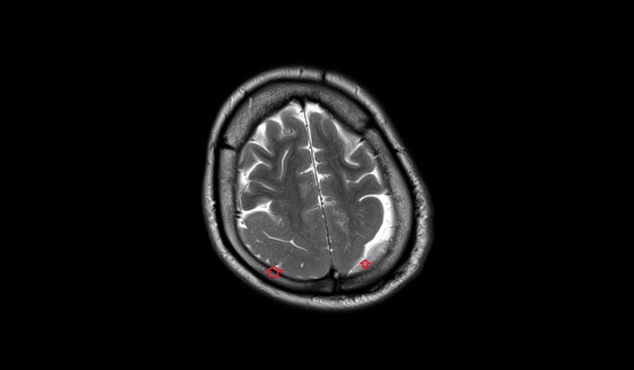 Pachygyria MRI | Radiology Article on Oligodendroglioma