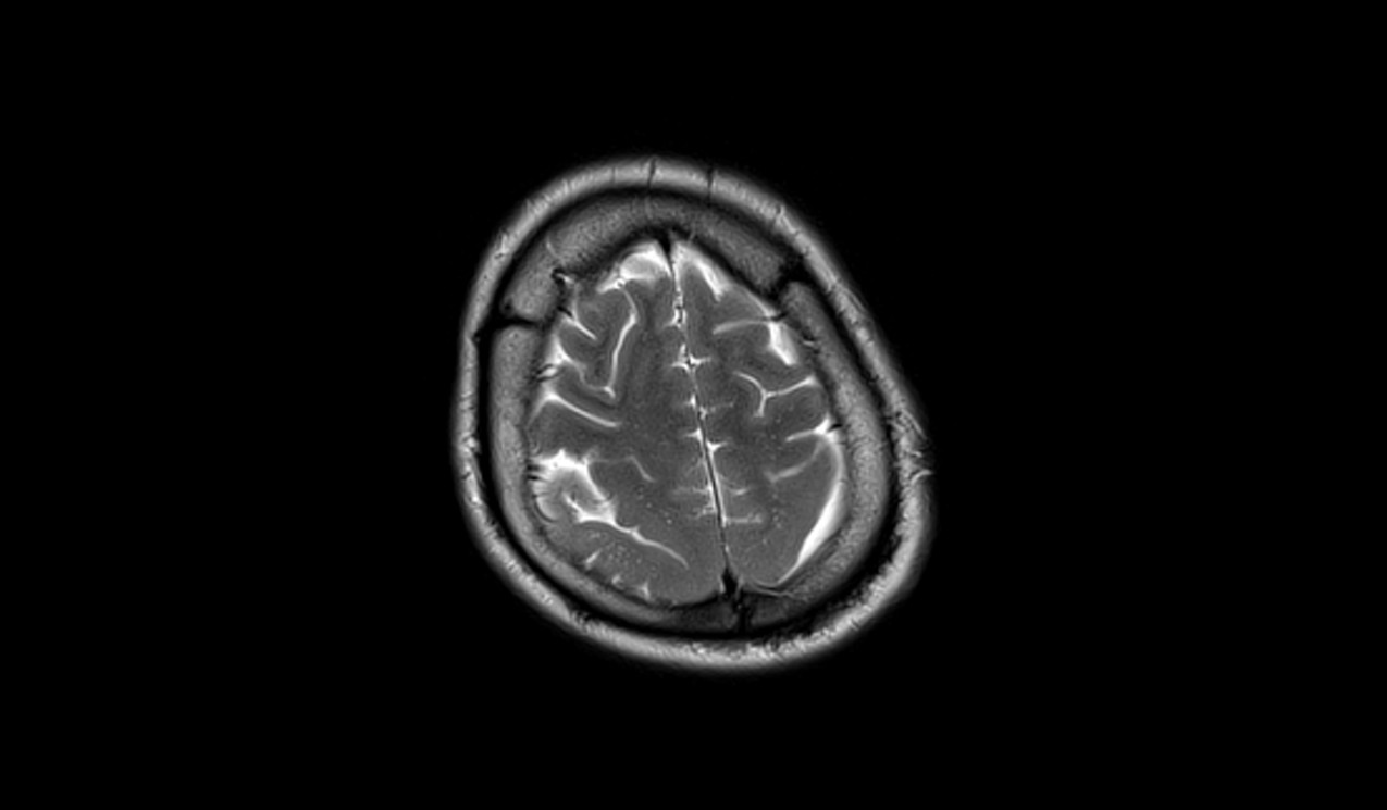 Pachygyria MRI | Radiology Article on Oligodendroglioma