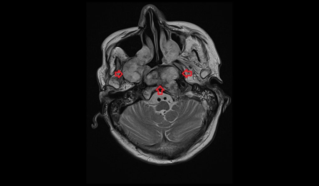 Clival Chordoma MRI | Radiology Article on Clival Chordoma