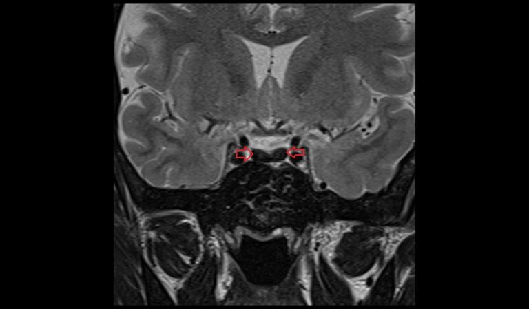 Pituitary Iron Overload (hemochromatosis) Mri 