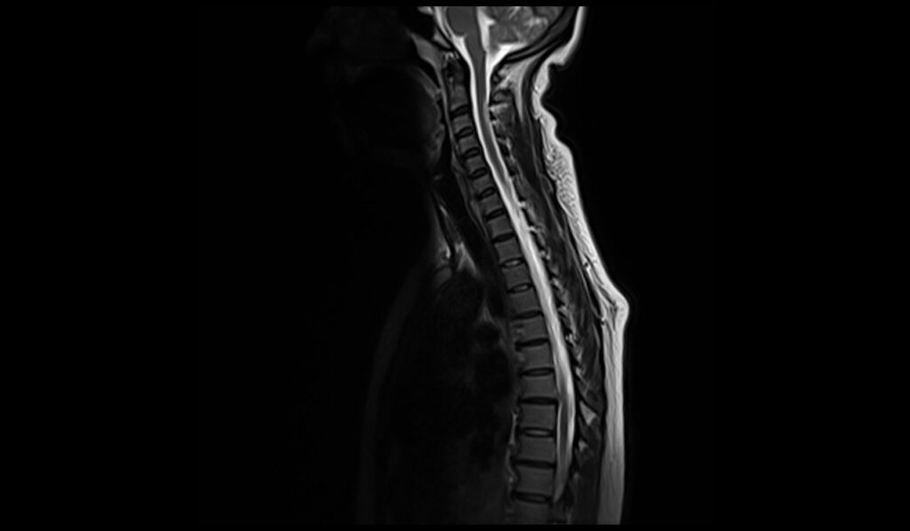 Nitrous oxide toxicity spinal cord MRI | Radiology article on Nitrous ...