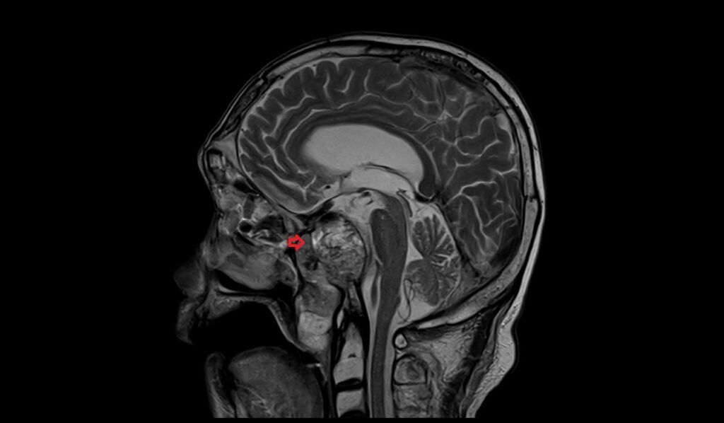 Clival Chordoma MRI | Radiology Article on Clival Chordoma