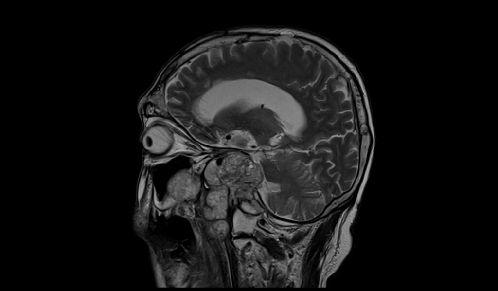 Clival Chordoma MRI | Radiology Article on Clival Chordoma