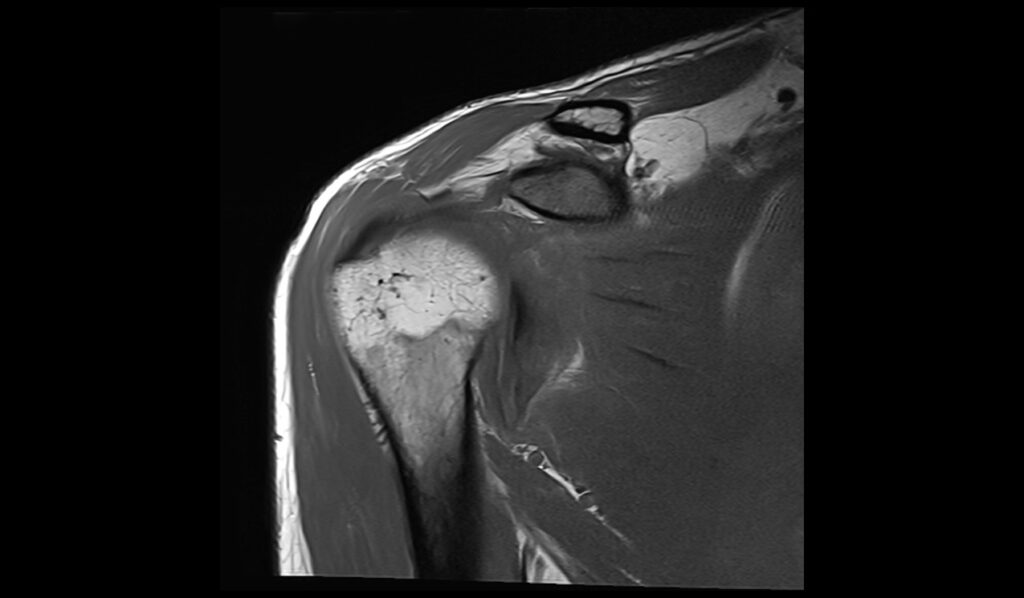 ALPSA Lesion MRI | Radiology Article on Anterior Labroligamentous ...