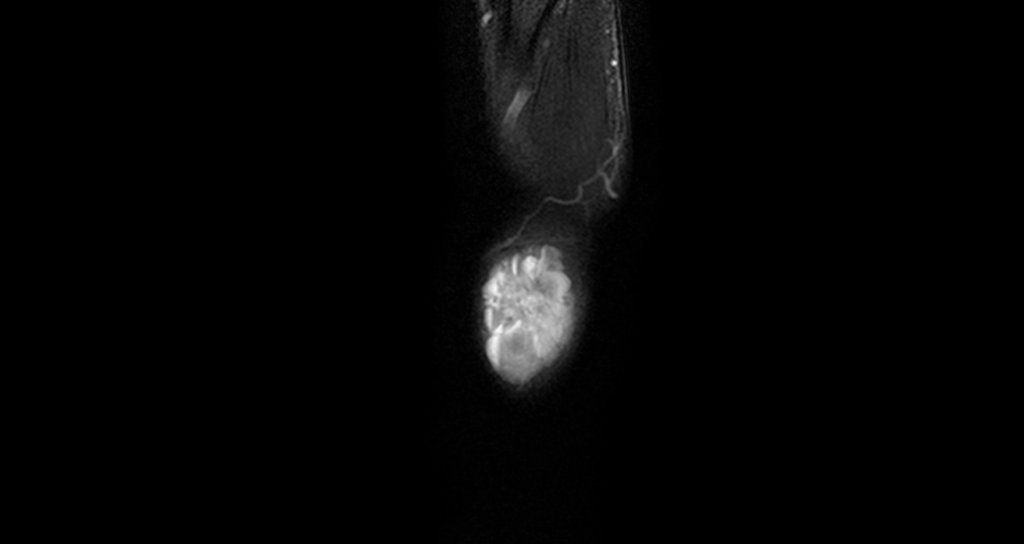wrist hemangioma mri sagittal stir image
