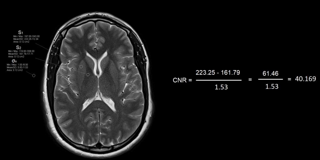 Angulo Cnr R Contrast-to-Noise Ratio (CNR) MRI | CNR Formula MRI