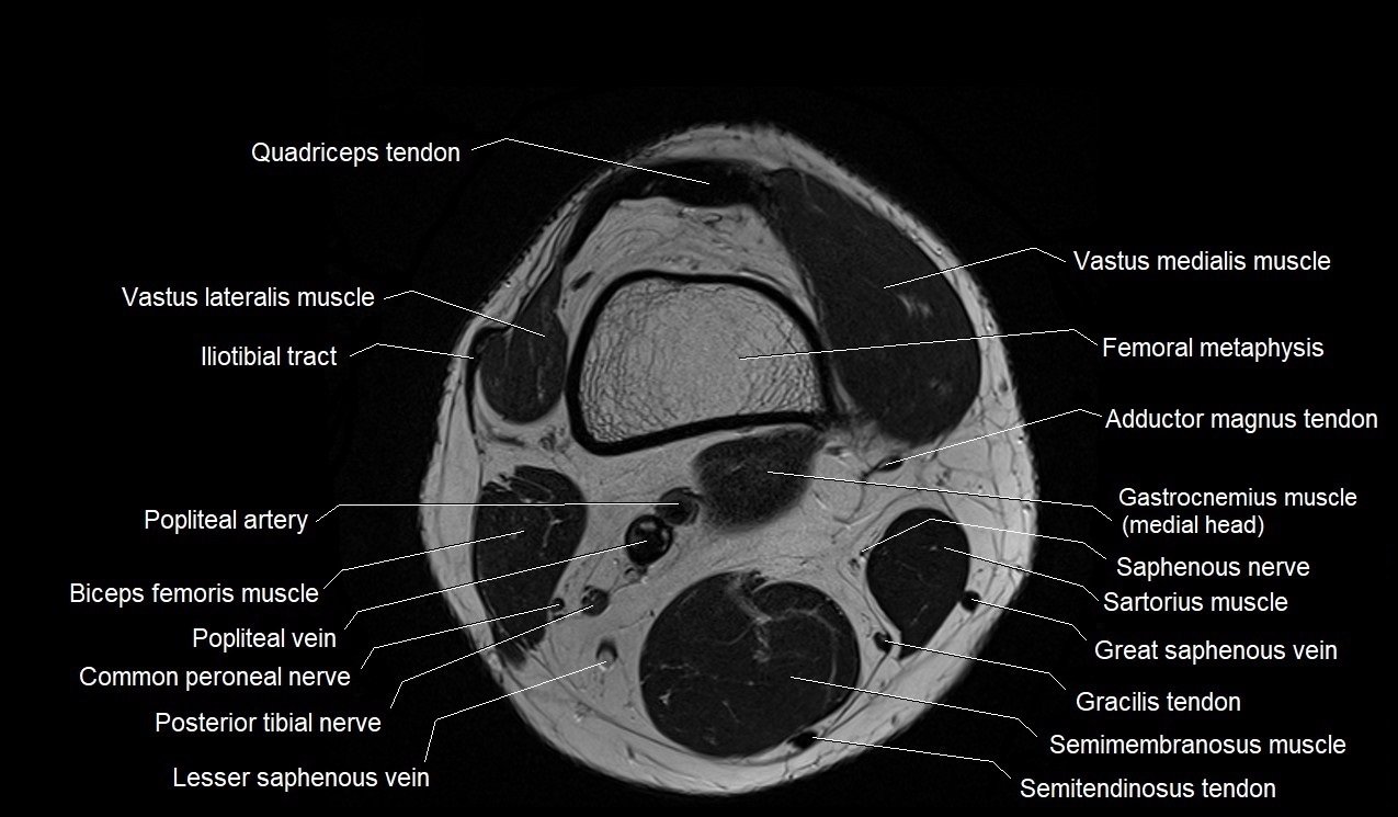 健康・医学 MRI ARTHROSCOPY and SURGICAL ANATOMY Sectional Anatomy by MRI and CT: 9780323394192: Medicine