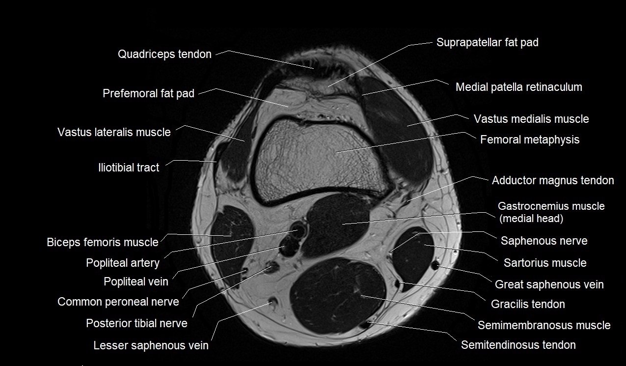 Cross Sectional Anatomy Mri The Knee (MRI): Atlas Of Anatomy In