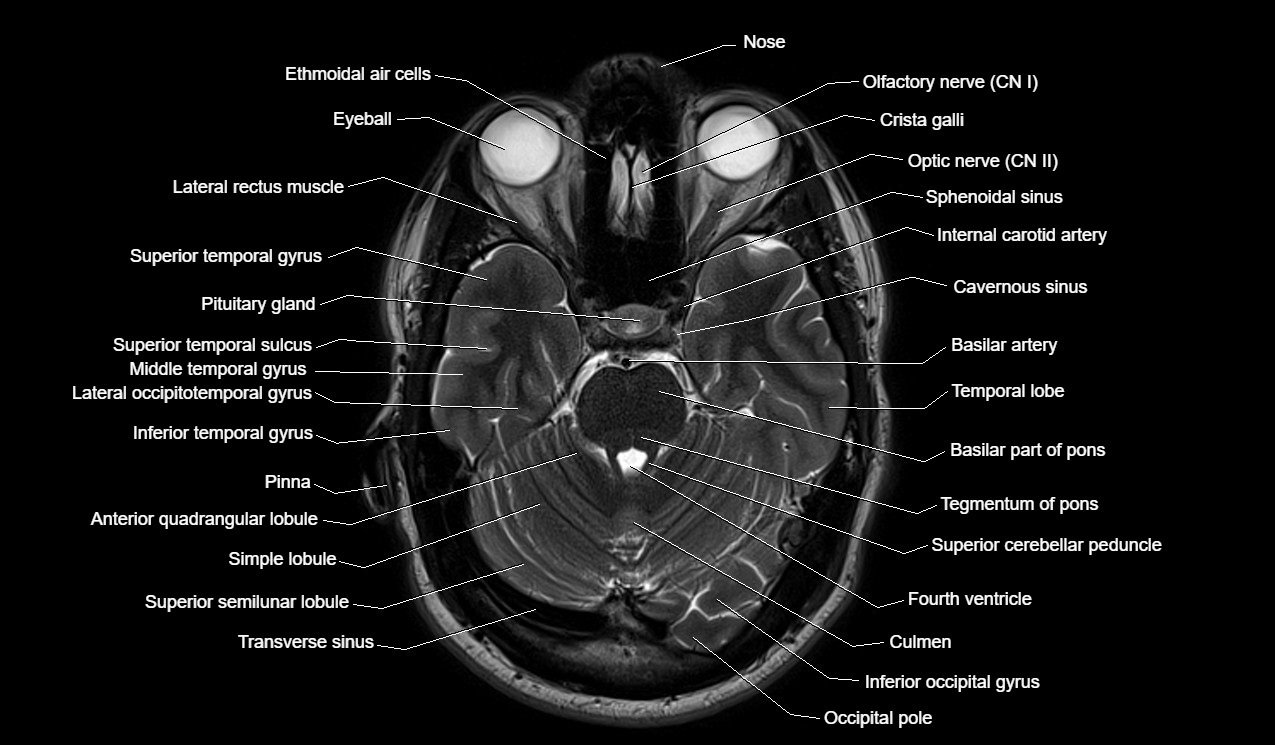 Brain Axial Anatomy