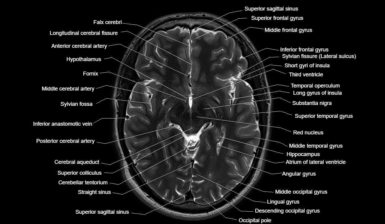 Cross Sectional Anatomy Mri Brain Sagittal Anatomy