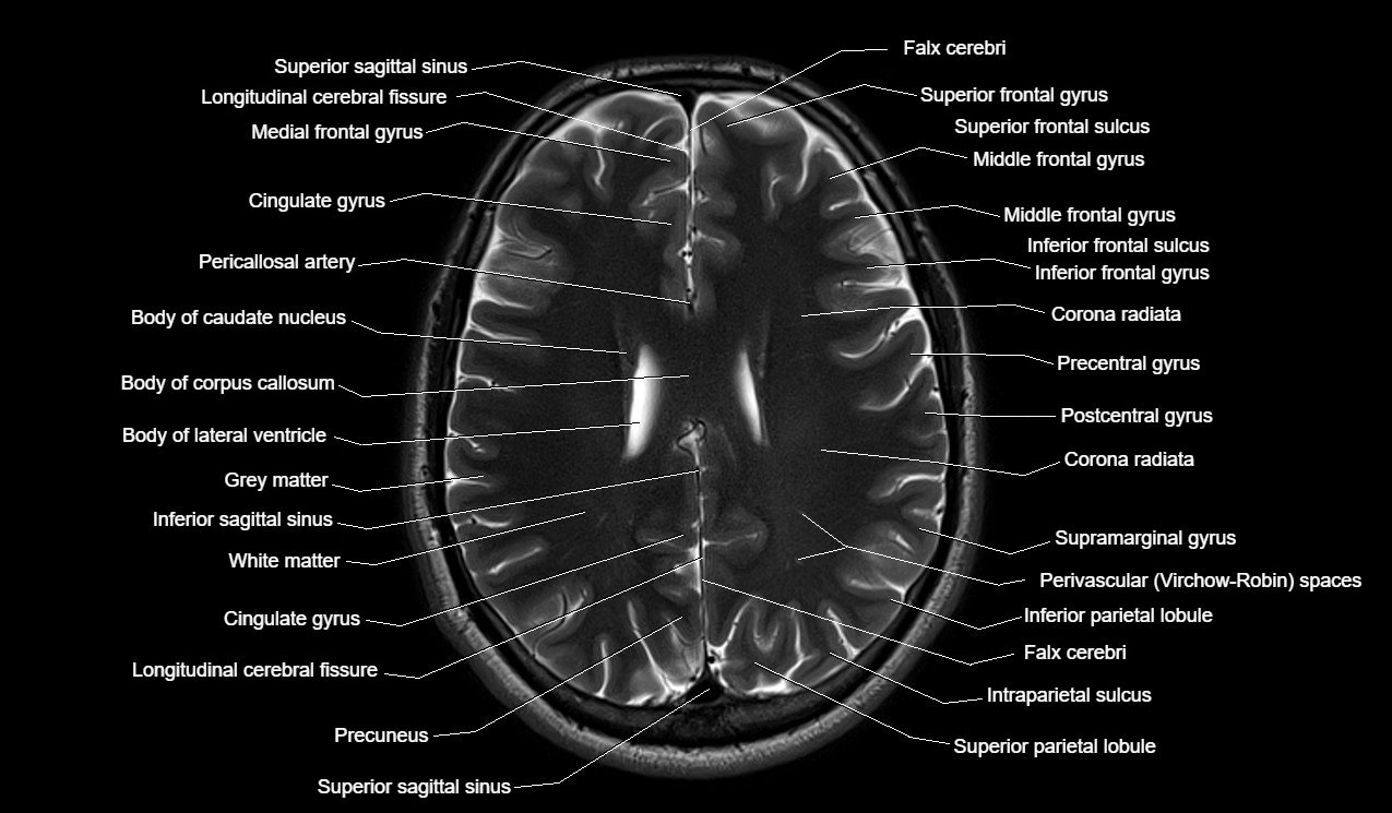 Mri Anatomy Brain Axial Image 9 Brain Anatomy Mri Brain Anatomy