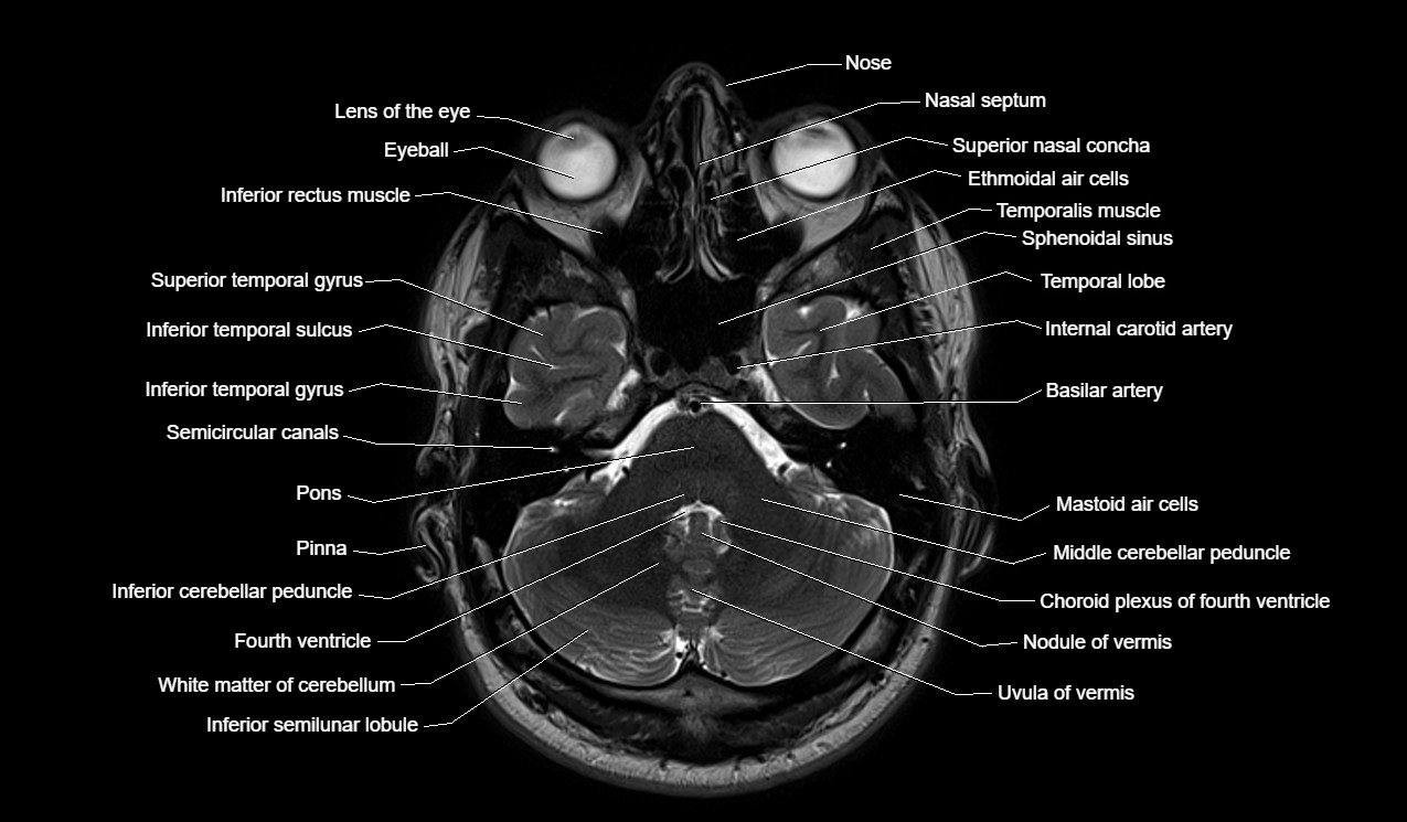 Mri Anatomy Brain Axial Image 9 Brain Anatomy Mri Brain Anatomy