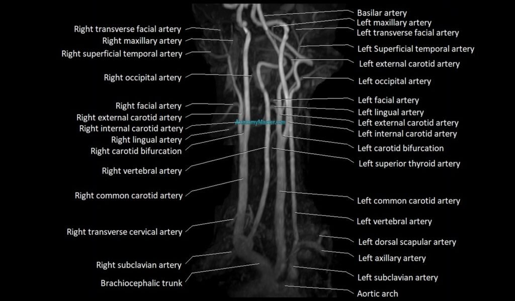 MRA carotid artery 3D MIP anatomy cross sectional 3T coronal image