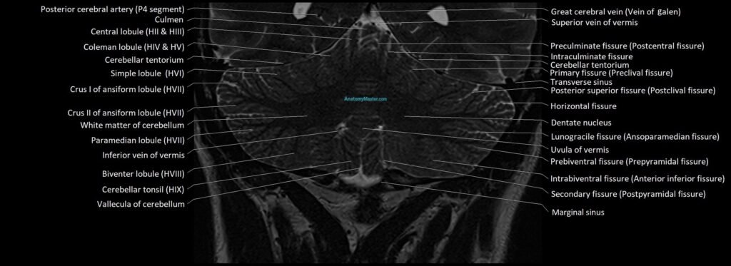 Anatomy of cerebellum coronal cross sectional 3T image