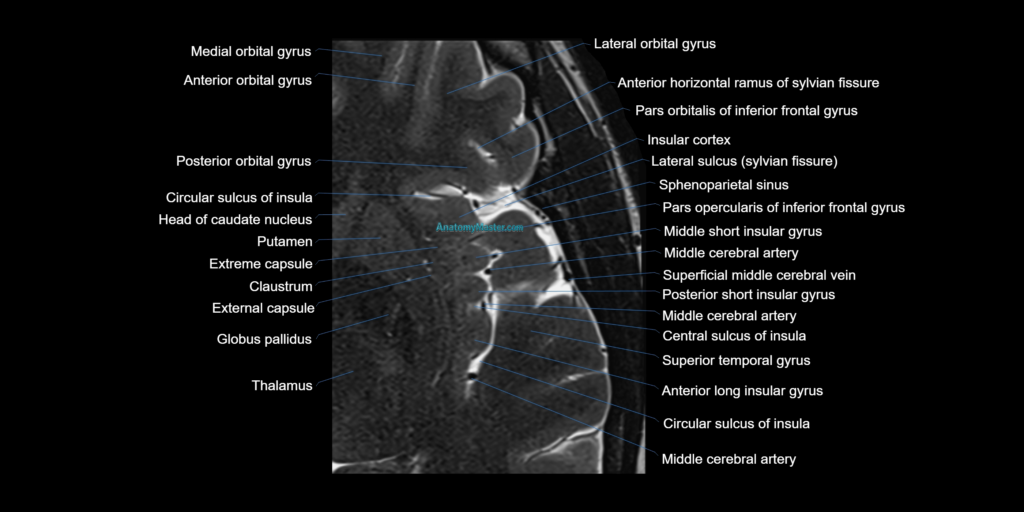 Brain insula axial anatomy 3T MRI image