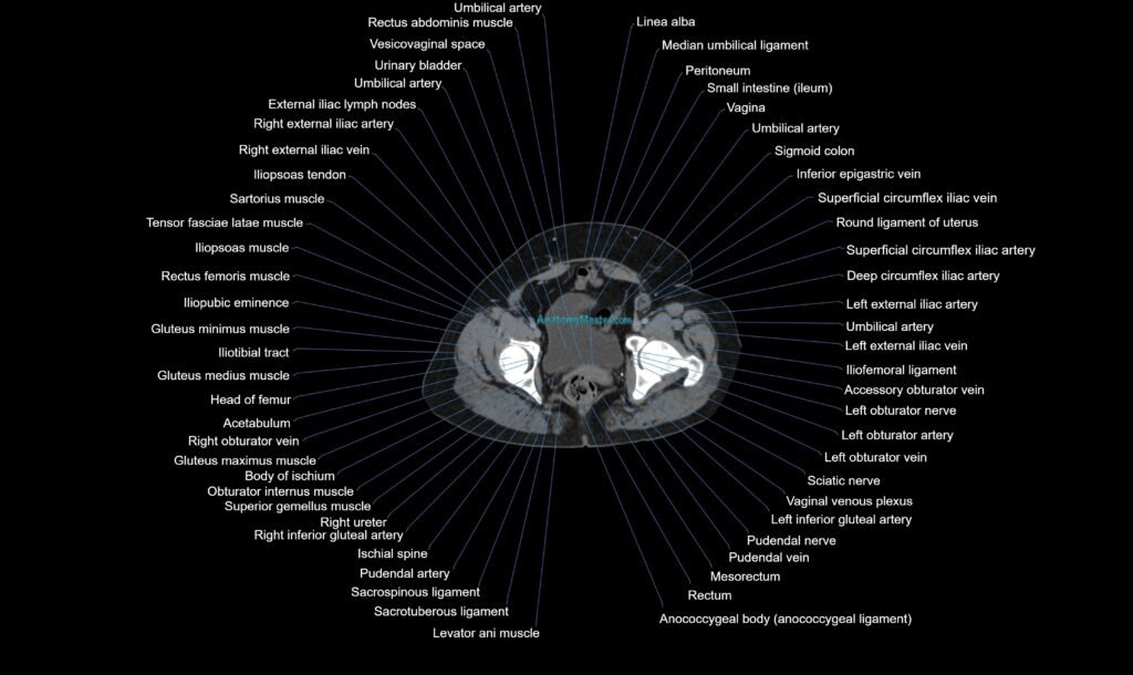 CT Abdomen axial cross sectional anatomy labelled radiology image