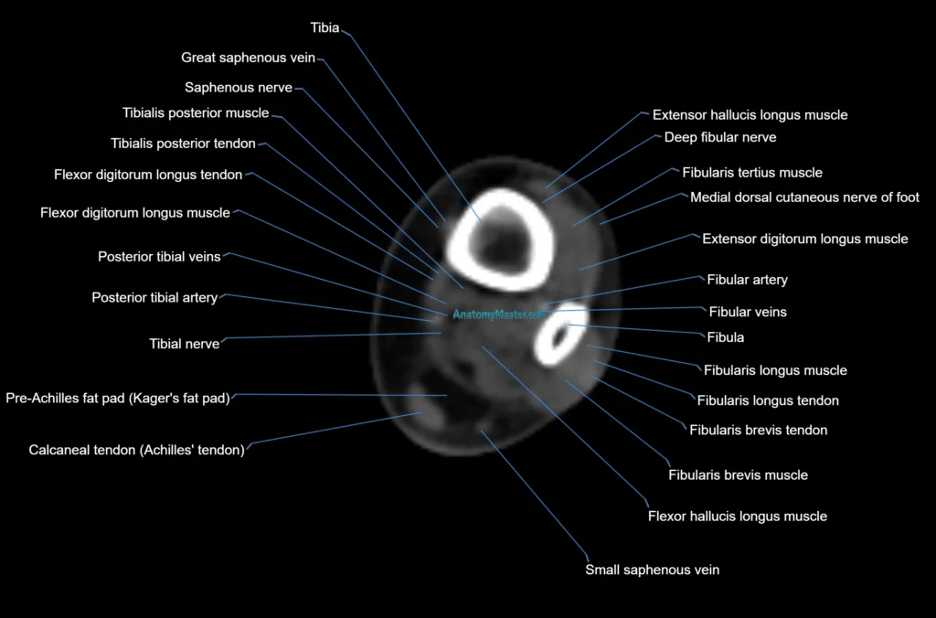 CT Ankle axial cross sectional anatomy radiology image