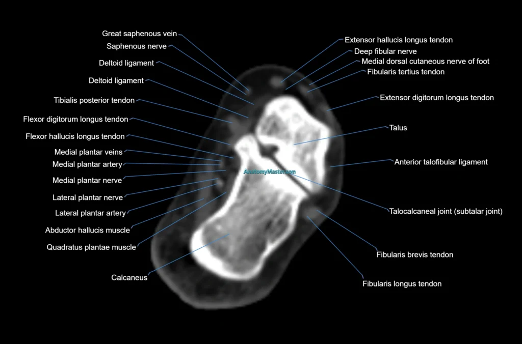 CT Ankle axial cross sectional anatomy radiology image
