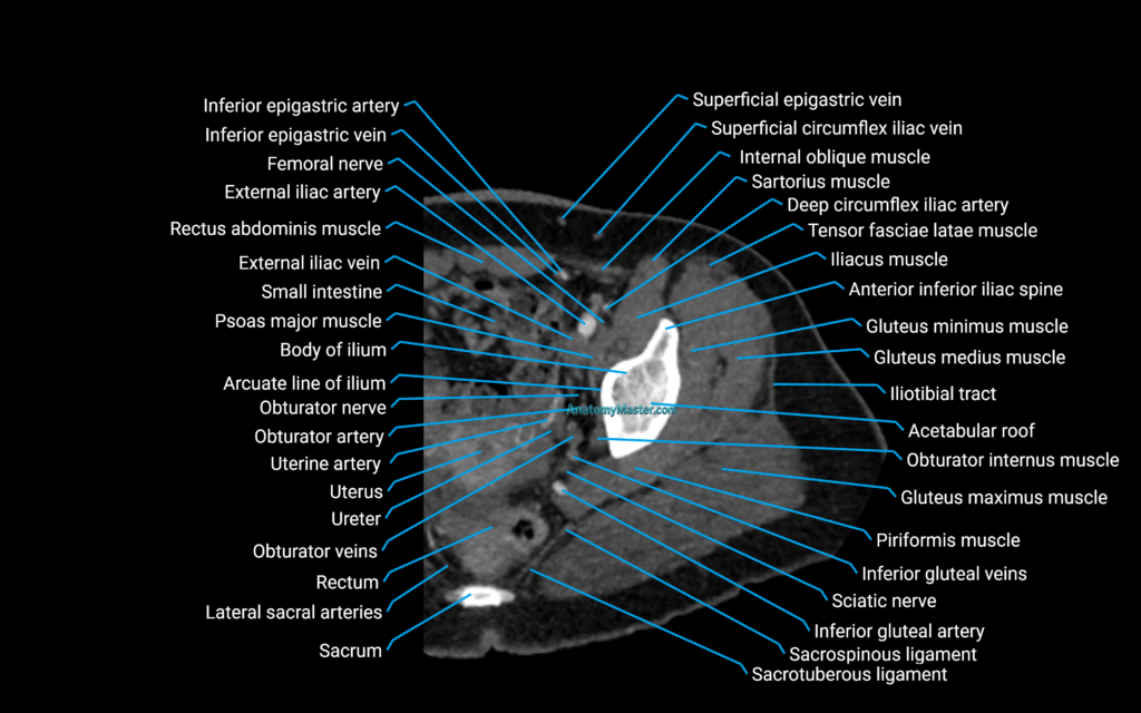 CT Hip axial cross sectional anatomy labelled image