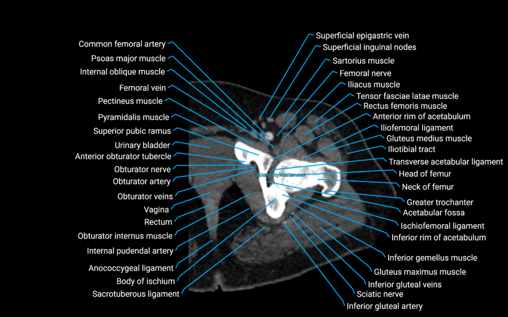 CT Hip axial cross sectional anatomy labelled image