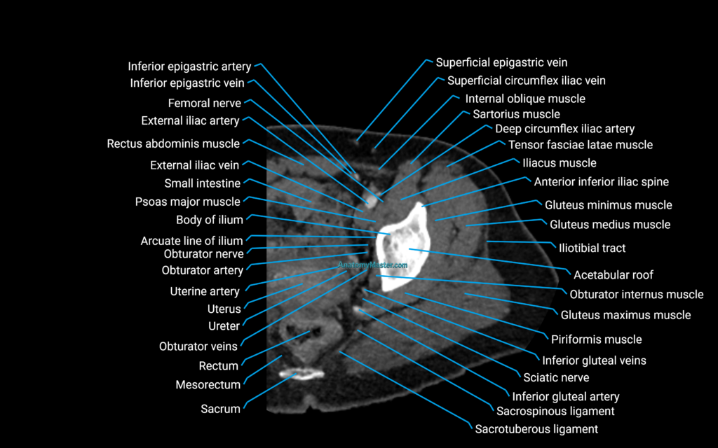 CT Hip axial cross sectional anatomy labelled image 2