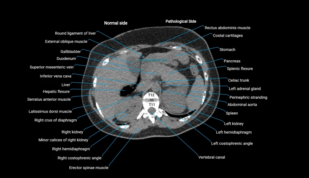 CT KUB axial cross sectional anatomy radiology image