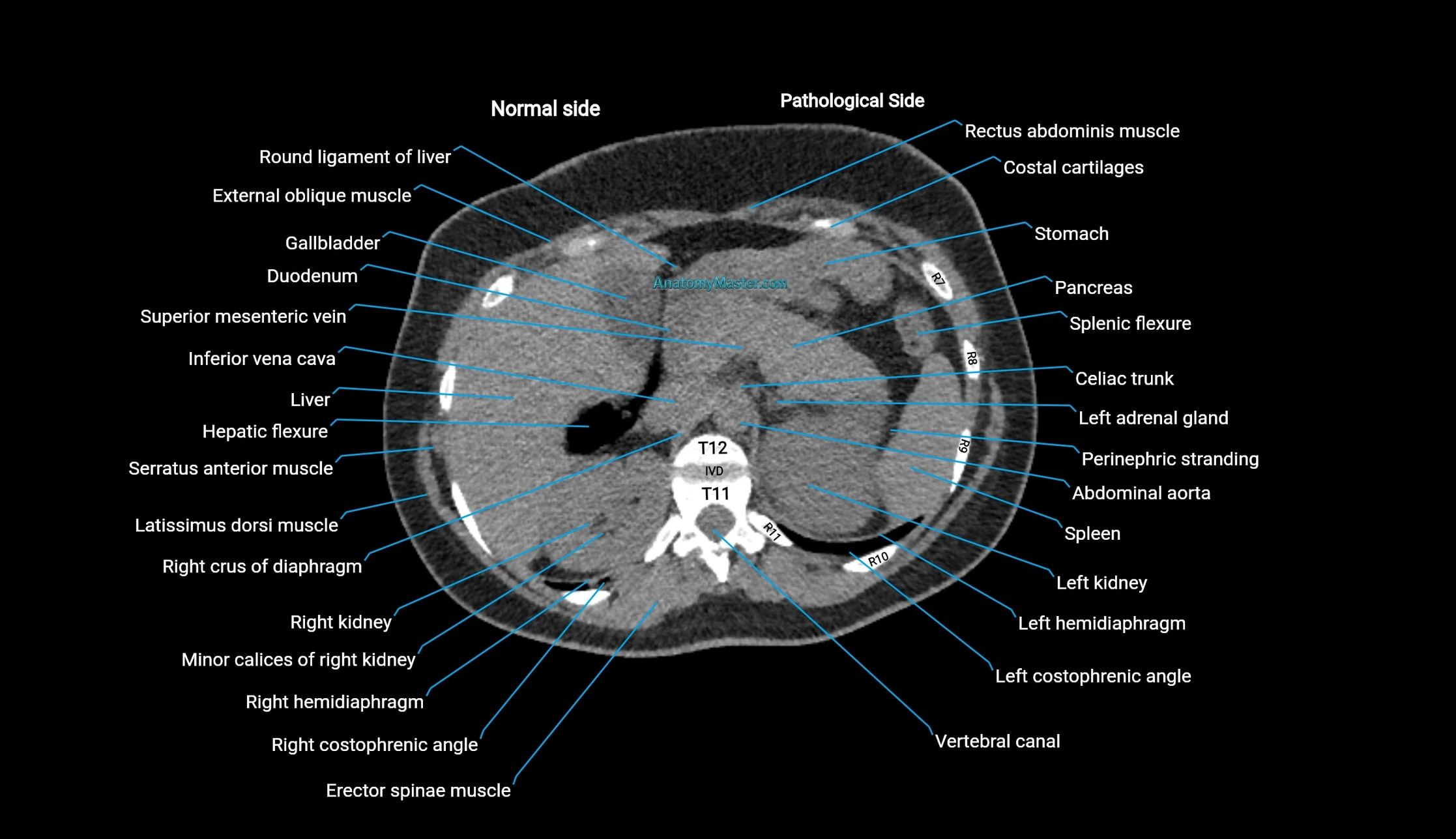 CT KUB Anatomy Atlas | Labelled Axial Images