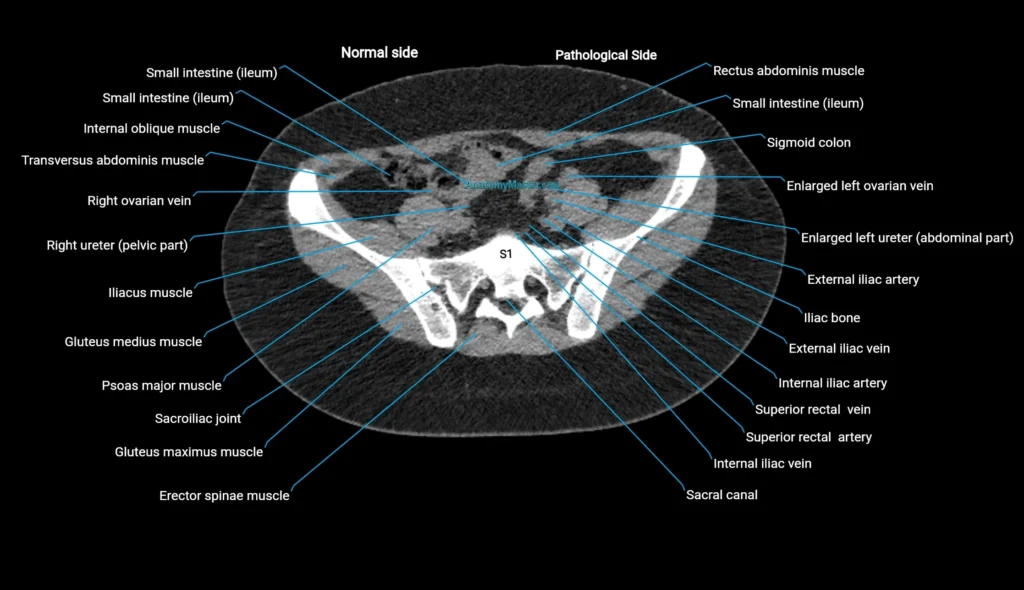 CT KUB axial cross sectional anatomy radiology image