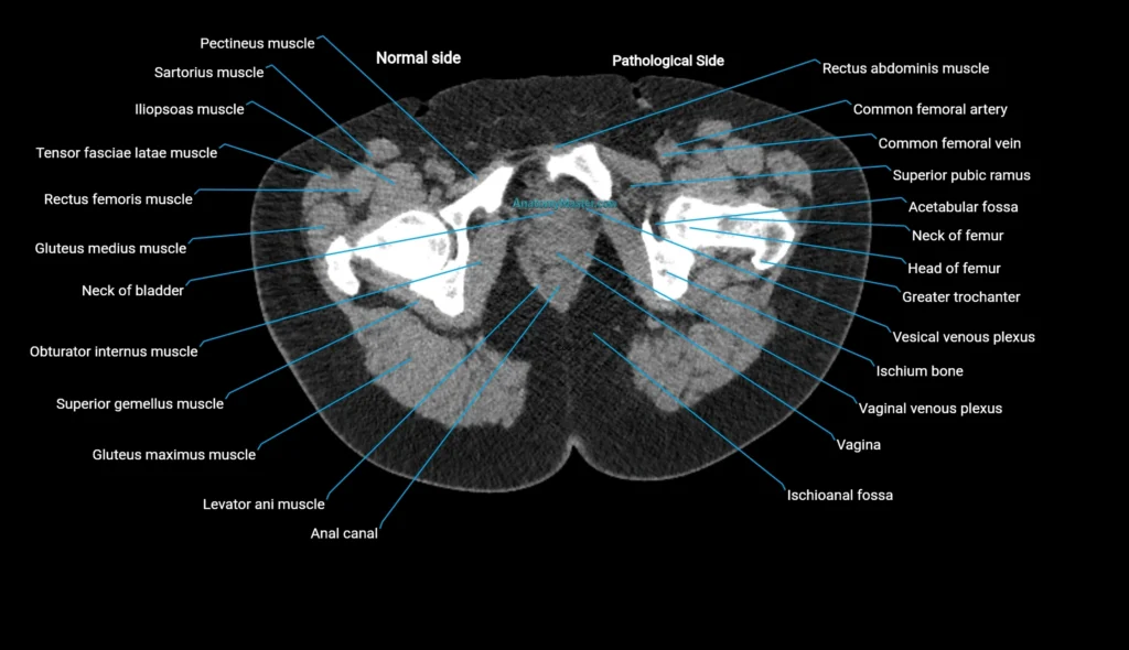 CT KUB axial cross sectional anatomy radiology image