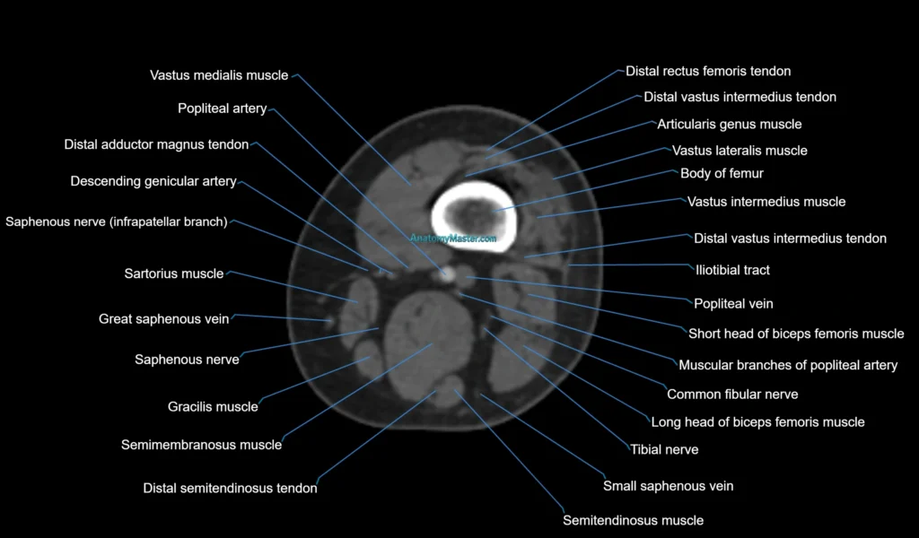 CT Knee axial cross sectional anatomy radiology image