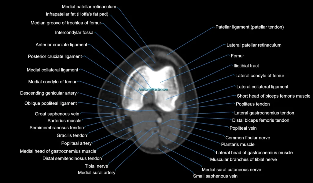 CT Knee axial cross sectional anatomy radiology image