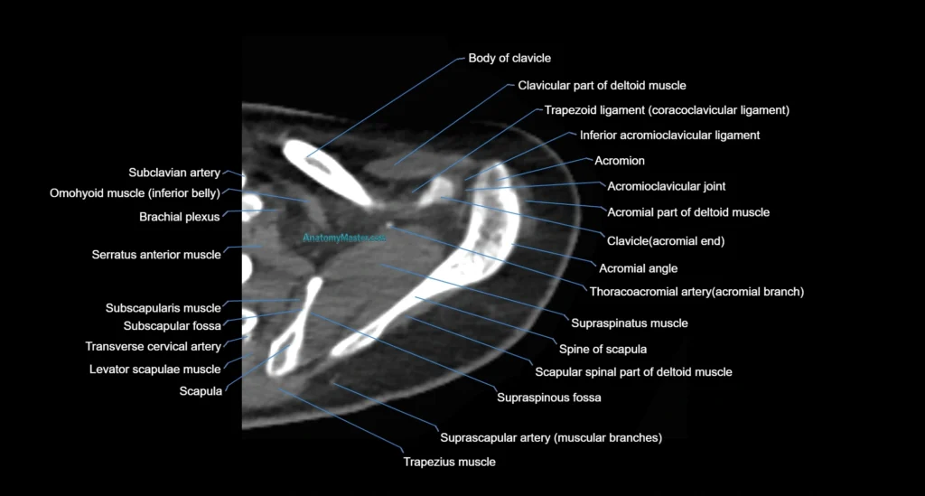CT Shoulder axial cross sectional anatomy radiology image