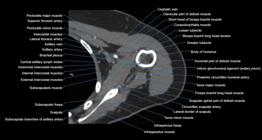 CT Shoulder axial cross sectional anatomy radiology image