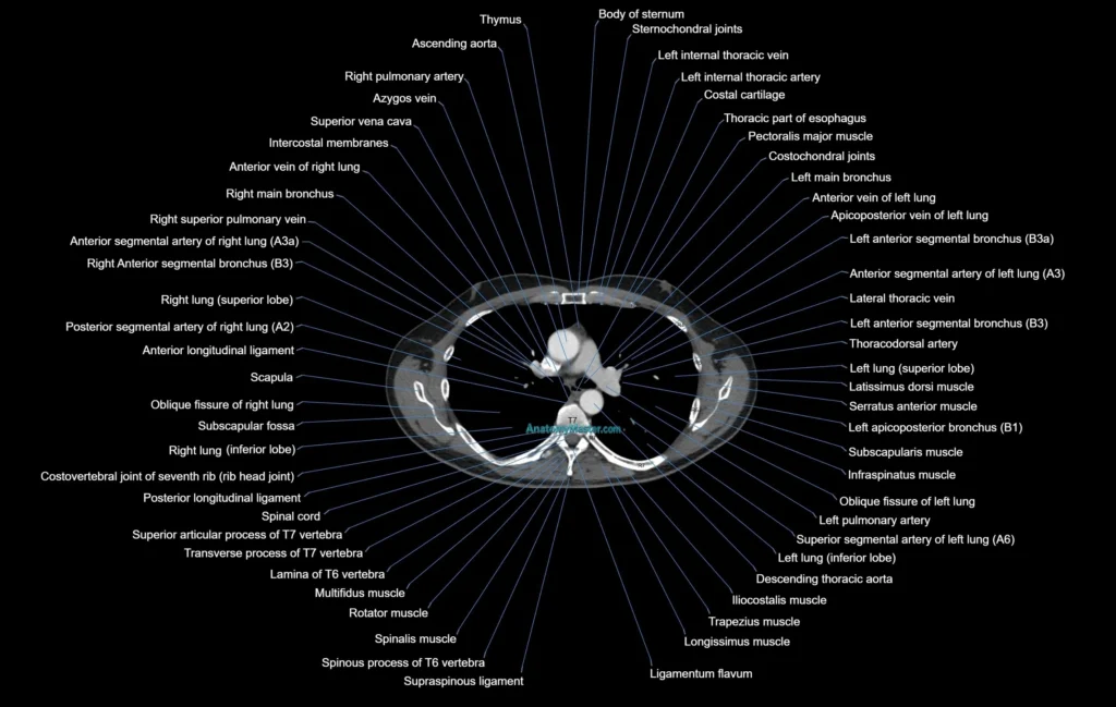 CT chest (thorax) labelled axial cross sectional anatomy radiology image