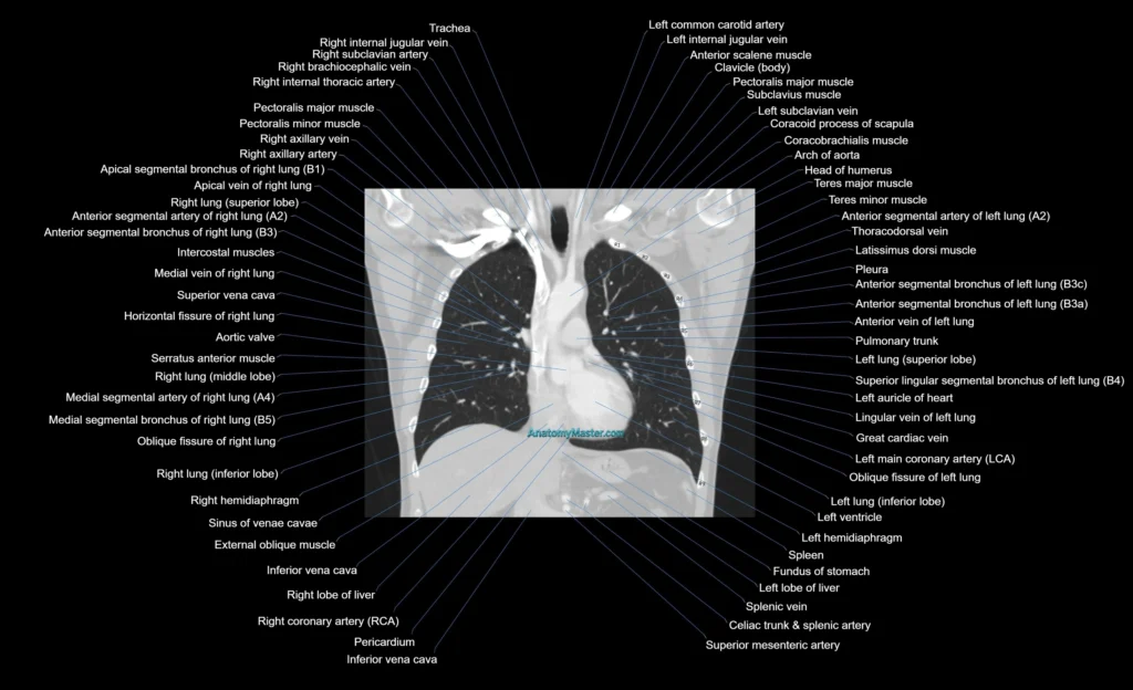 CT chest (thorax) labelled coronal cross sectional anatomy radiology image