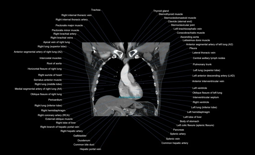 CT chest (thorax) labelled coronal cross sectional anatomy radiology image