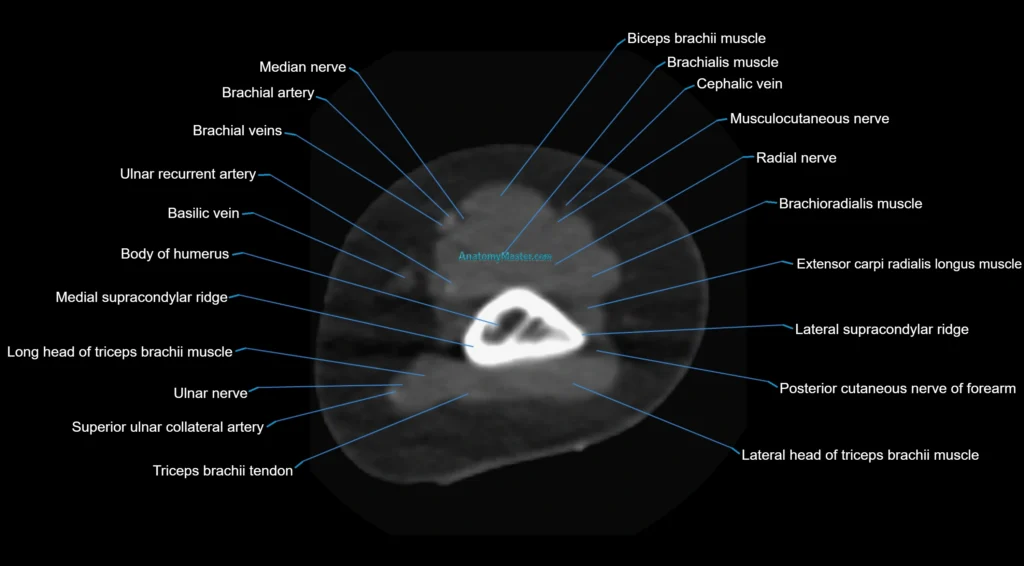 CT elbow axial cross sectional anatomy radiology image