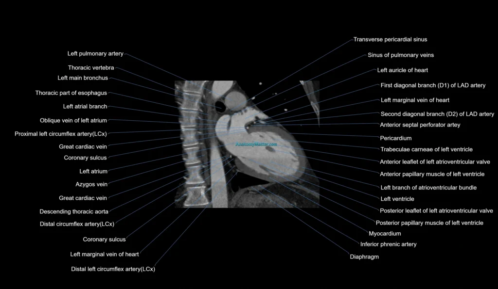 CT heart (coronary angiogram) 2 chamber view cross sectional anatomy labelled radiology image