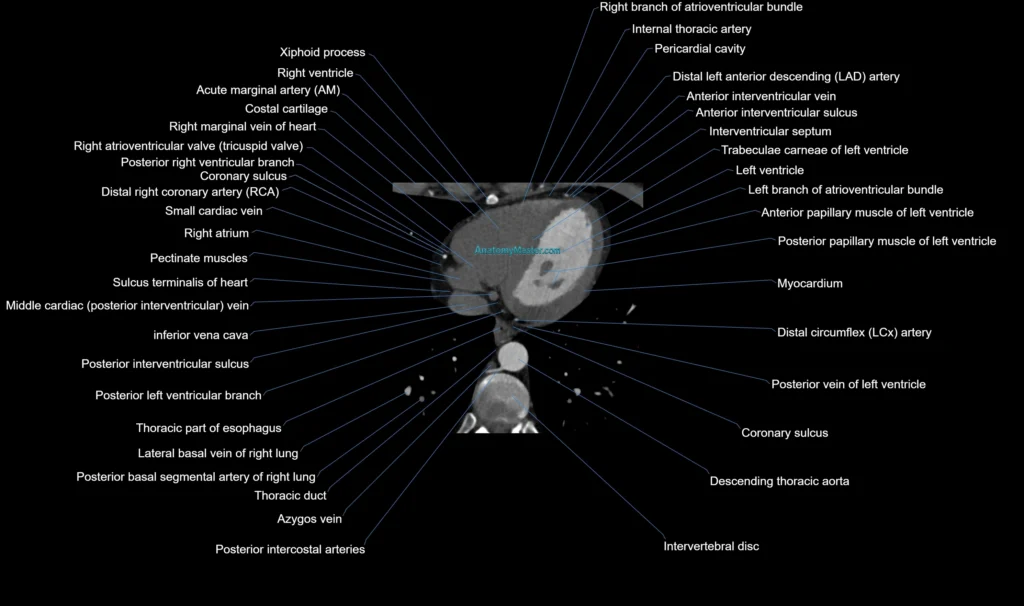 CT heart (coronary angiogram) axial view cross sectional anatomy labelled radiology image